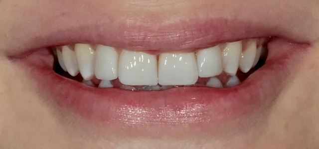 4 Non-Prep Veneers auf den Zähnen 12–22