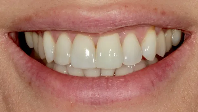 2 Non-Prep Veneers auf den Zähnen 12, 11 und eine neue vollkeramische Krone auf Zahn 21