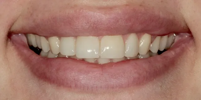 4 Non-Prep Veneers auf den Zähnen 12–22