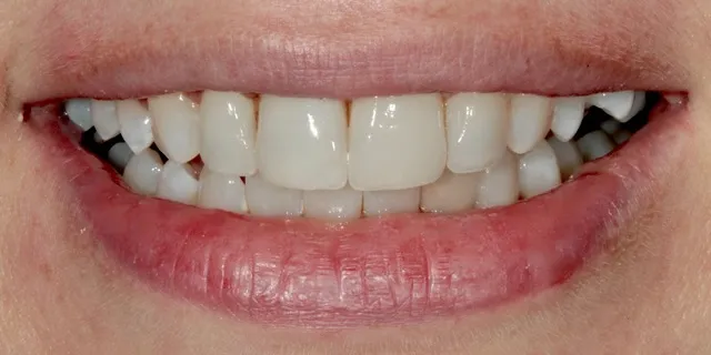 Bleaching und 4 Non-Prep Veneers auf den Zähnen 12–22