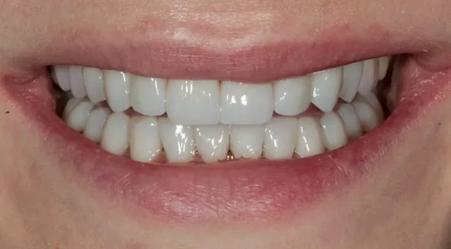 24 Non-Prep Veneers im Ober- und Unterkiefer