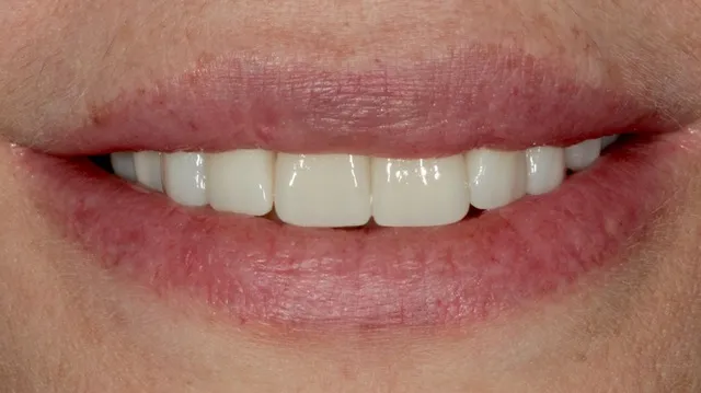 8 Non-Prep Veneers auf den Zähnen 15–23 und Implantatkrone für Zahn 24