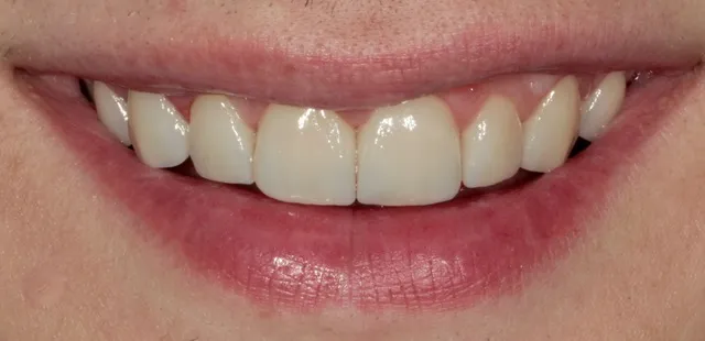 10 Non-Prep Veneers auf den Zähnen 15–25