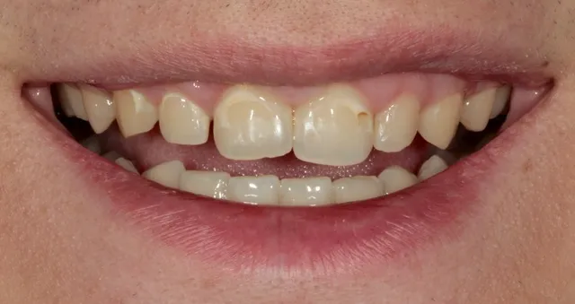 Unschöne Frontzähne mit White Spots