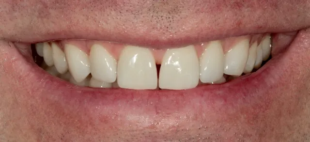 6 Non-Prep Veneers auf den Zähnen 13–23