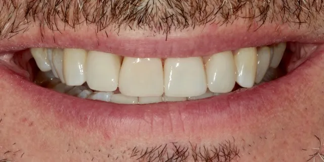 3 Non-Prep Veneers auf den Zähnen 12, 11 und 21