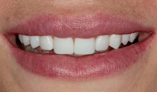 10 Non-Prep Veneers auf den Zähnen 15–25