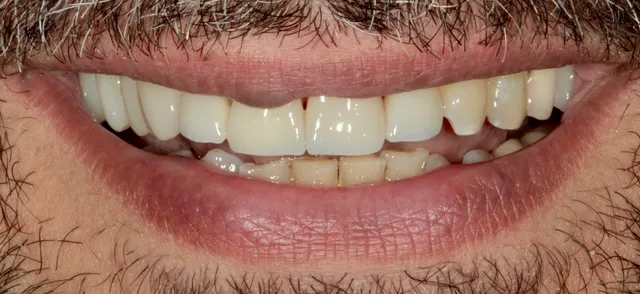 4 Non-Prep Veneers auf den Zähnen 12–22